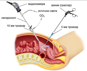 Удаление кисты яичника